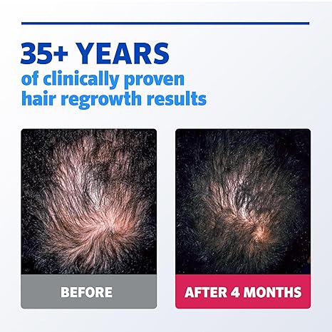 Men’s Rogaine Extra Strength 5% Minoxidil, Topical Solution for Thinning & Hair Loss, Clinically Proven FDA Approved Minoxidil for Men Treatment, Regrow Fuller Hair, 3 Month Supply, 3 Bottles